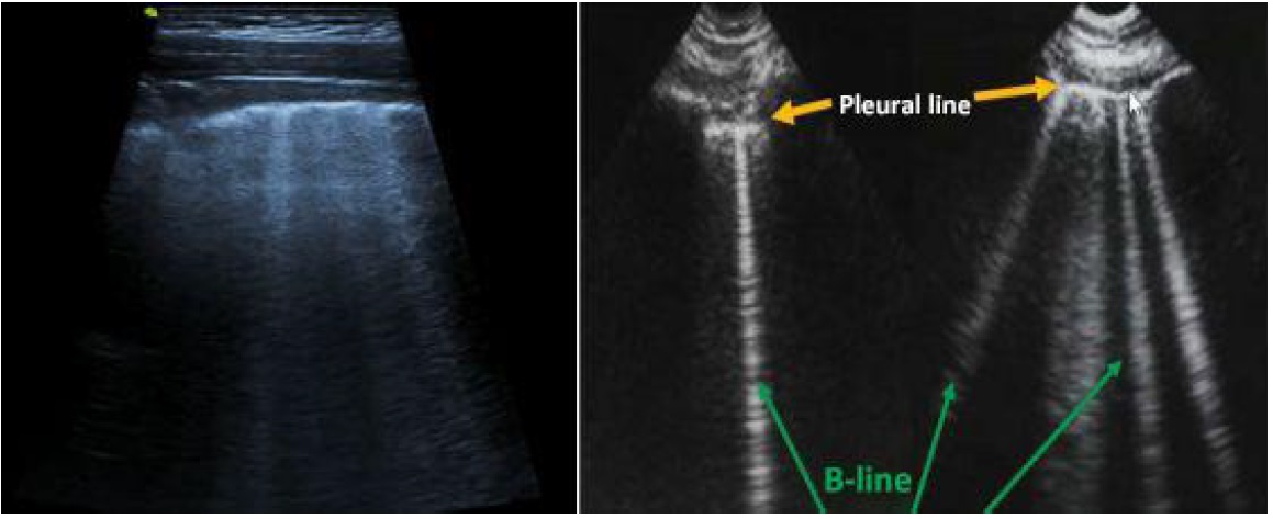Ecógrafia pulmonar en pacientes con COVID-19 - VINNO Spain